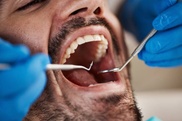 Best Dental Abscess Treatment in South Lockport, NY
