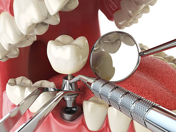 Best Emergency Denture Repair in South Lockport, NY